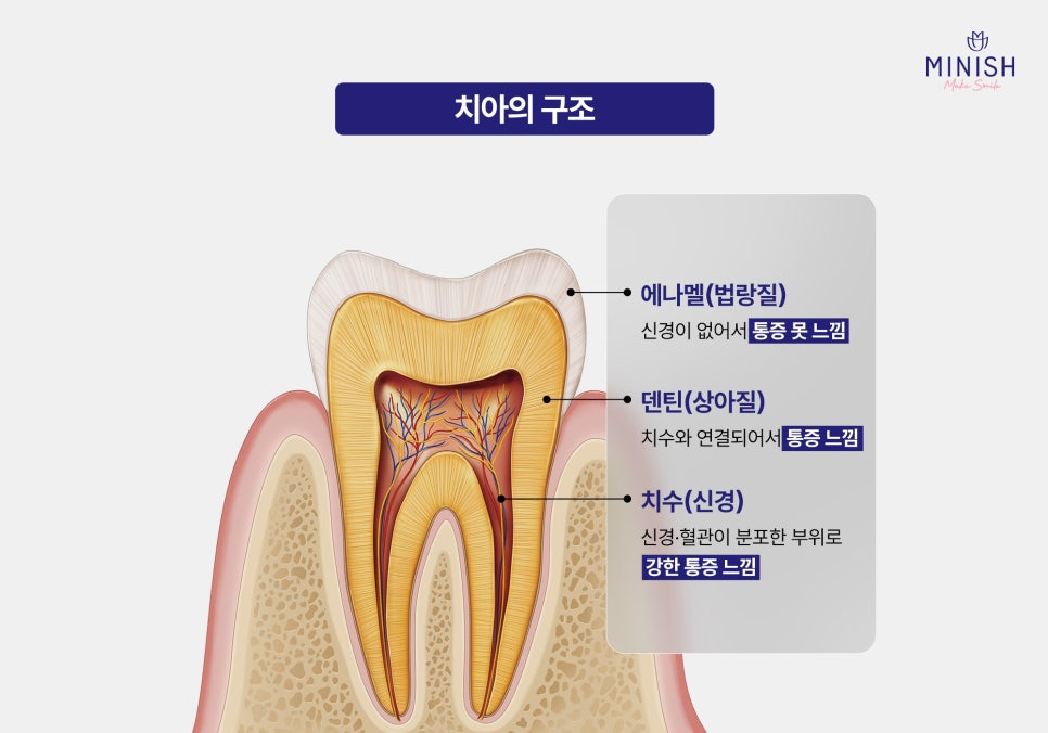 Laminates Retreatment: Be Sure to Know This Before You Proceed! image 3