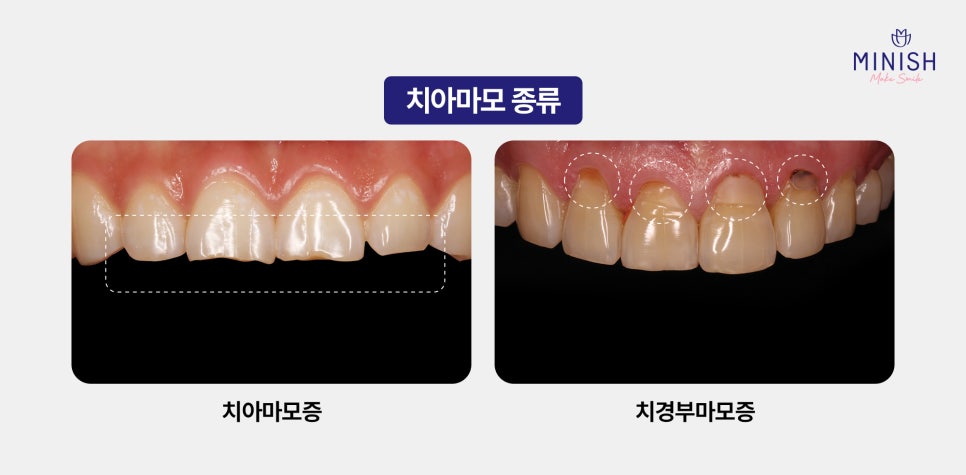 치아마모, 치아노화 증상 치료 치아 안티에이징으로 해결 관련 이미지 2