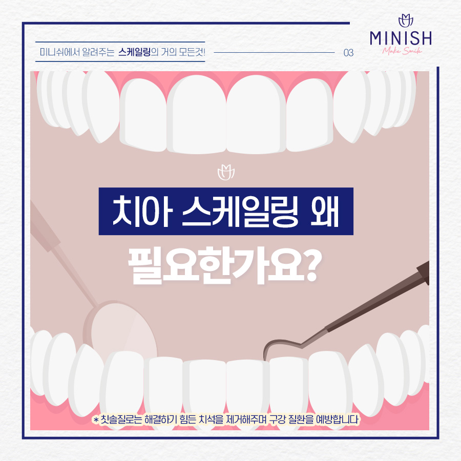 치과 스케일링의 거의 모든 것 관련 이미지 3