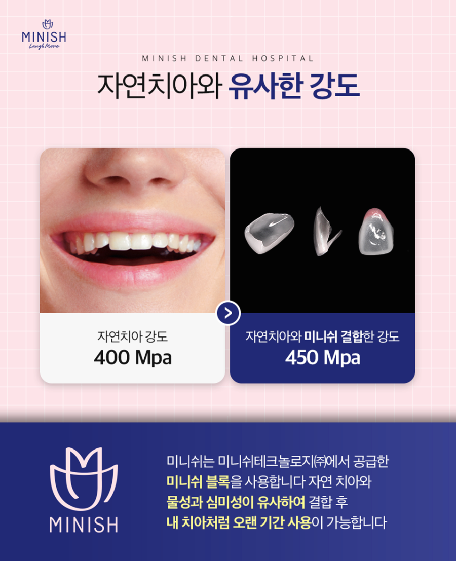학동치과 앞니 손상으로 치아 보호 및 심미적 대처가 필요하다면 관련 이미지 2