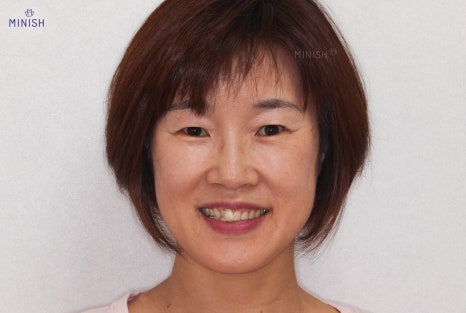 틀어진 앞니 하루만에 해결! (미니쉬, 라미네이트, 부분교정) 관련 이미지 6