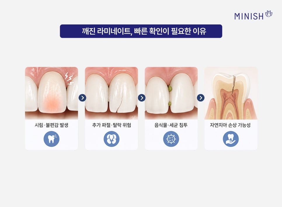 앞니 라미네이트 깨짐, 재치료가 필요하다면? 관련 이미지 3