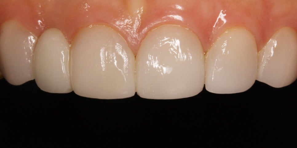 강남구청치과 건강한 아름다움, 미니쉬로 활짝 핀 자신감을 선물해 드립니다 관련 이미지 4