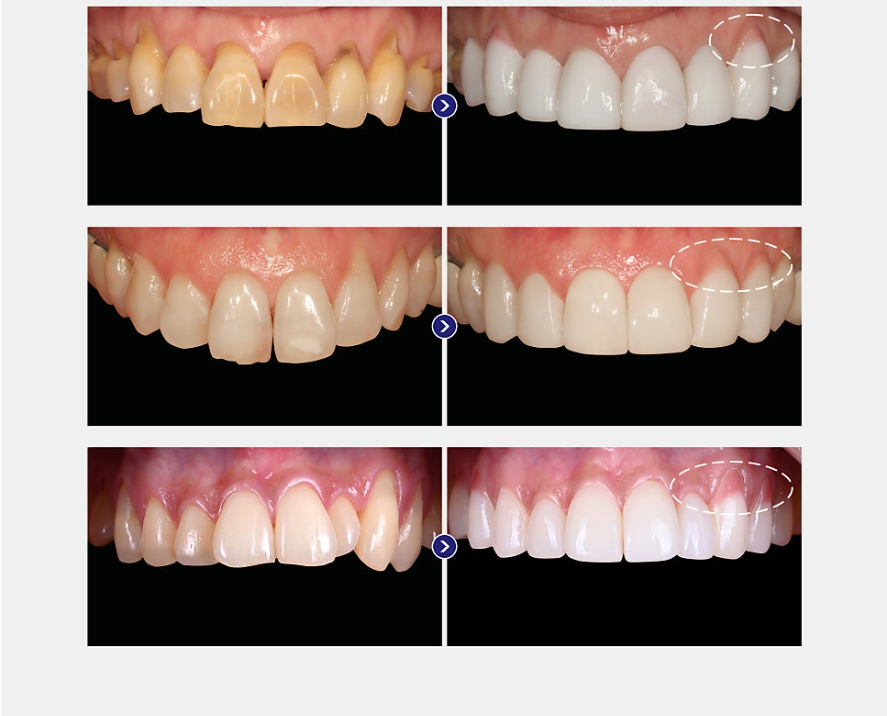 Causes of Receding Gums, Early Signs of Gum Disease, and When Gum Disease Treatment Is Needed image 8