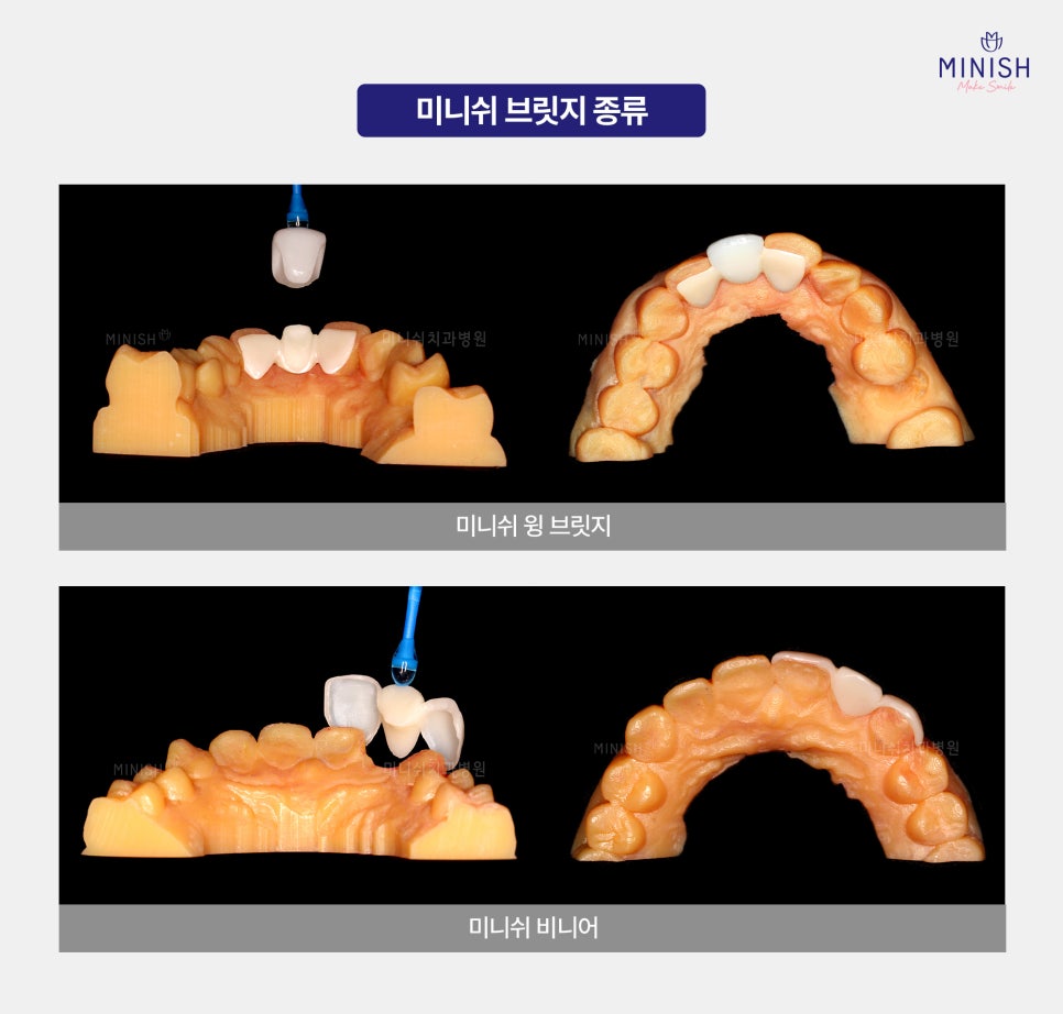 How Can You Restore Healthy Teeth After Tooth Loss Without Surgery? image 4