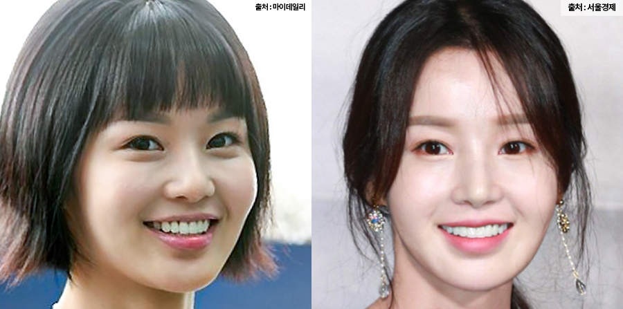 치아교정 고민, 미니쉬하모니로 관련 이미지 4