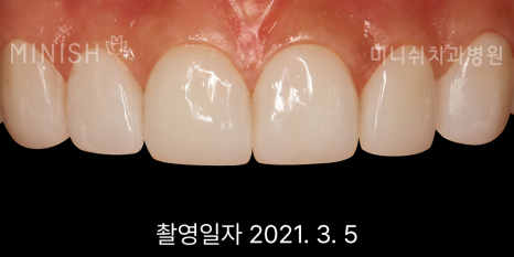 벌어진 앞니 치료 방법 세가지 장단점 관련 이미지 8