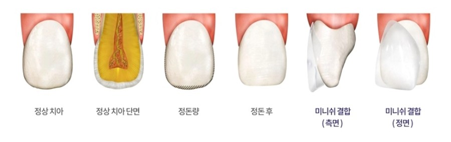 신사역치과 첫인상을 결정하는 밝은 미소 이렇게 되찾으세요 관련 이미지 4