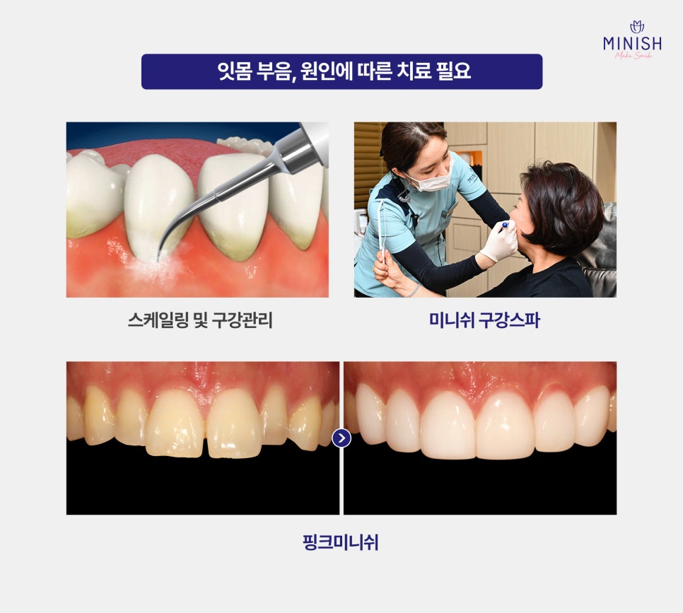 잇몸 부음 왜 생길까? 통증 반복될 때 꼭 확인해야 할 것 관련 이미지 5
