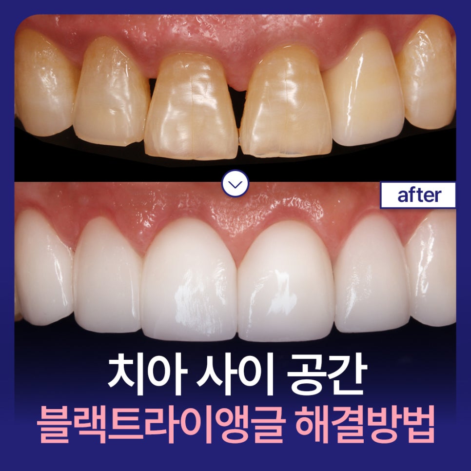 블랙트라이앵글 원인과 레진, 미니쉬 해결 방법 관련 이미지 1