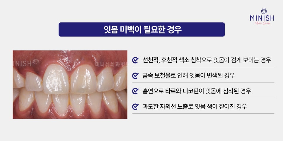 잇몸이 까매요 잇몸미백 필요한 경우 알아보기 관련 이미지 4