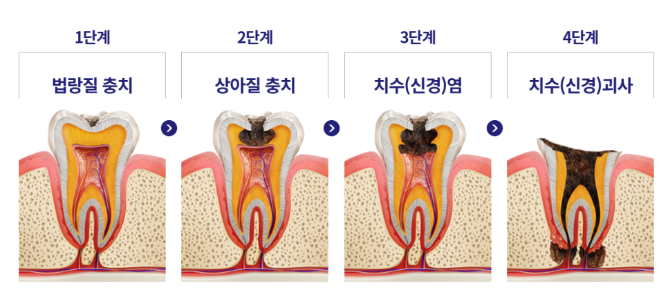 입냄새 원인 별 예방과 제거 치료 방법은? 관련 이미지 3