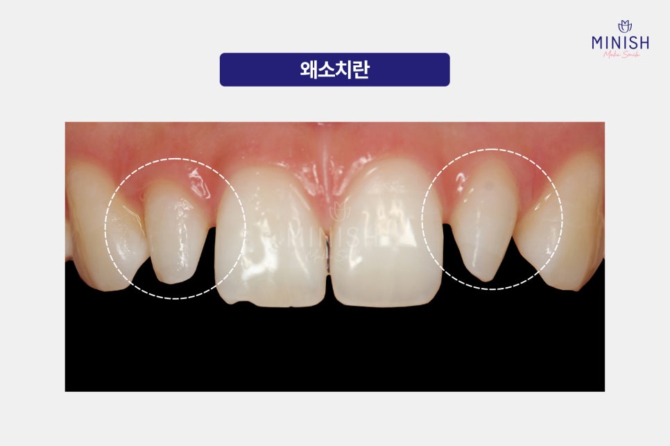 Small Teeth, Hypodontia: What Is a Healthy Way to Improve Them? image 2