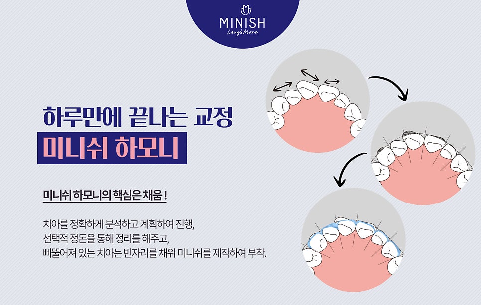 부정교합종류, 하루만에 교정할 수 있는 방법도 있을까? 관련 이미지 9
