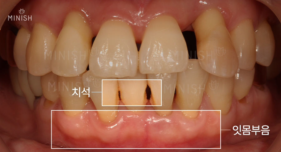 치아성형 고민? 미니쉬치과 병원에서 해결! 관련 이미지 6