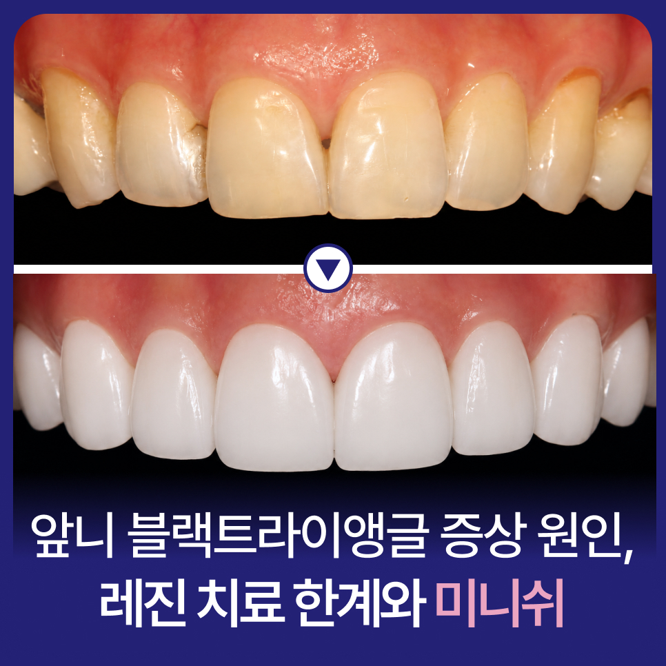 앞니 블랙트라이앵글 증상 원인, 레진 치료 한계와 미니쉬 관련 이미지 1