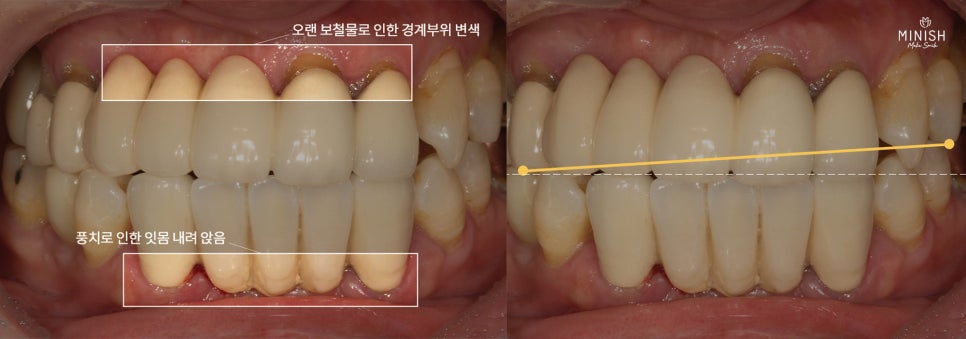 Can Teeth That Have Become Longer Due to Gum Recession Be Restored Healthily? image 2