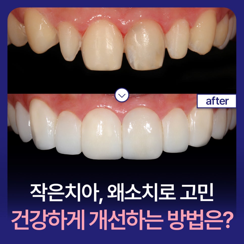 Small Teeth, Hypodontia: What Is a Healthy Way to Improve Them? image 1