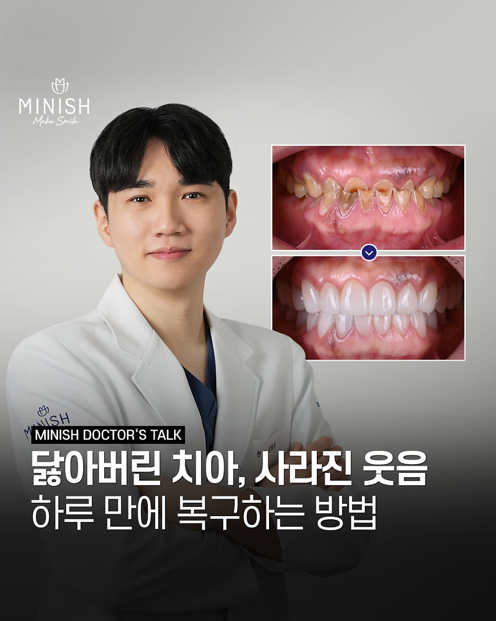 If Your Teeth Have Worn Down and Even Changed Your Face, Can They Be Restored? A Case Repaired with Minishe image 1