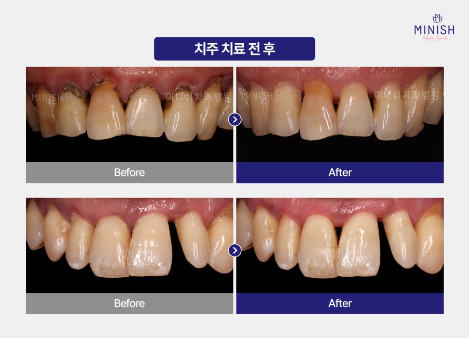 Bad Breath Causes: Could They Be More Serious Than You Think? A Summary of Solutions! image 7