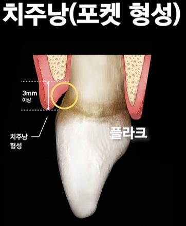 잇몸염증은 구강 적신호...가장 적극적인 잇몸치료는 미니쉬 관련 이미지 4