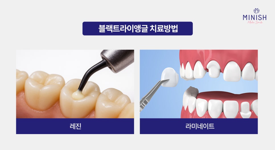 Black Triangles Between Teeth: Restore Them Healthily with Minishe! image 4