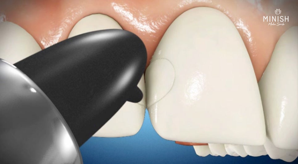 Rough, Speckled Tooth Surfaces? Enamel Hypoplasia image 5