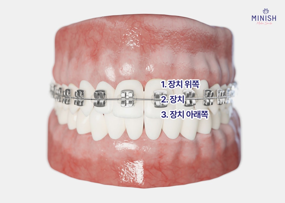 치아교정 양치질이 중요한 이유와 올바른 방법까지 알려드려요 관련 이미지 4