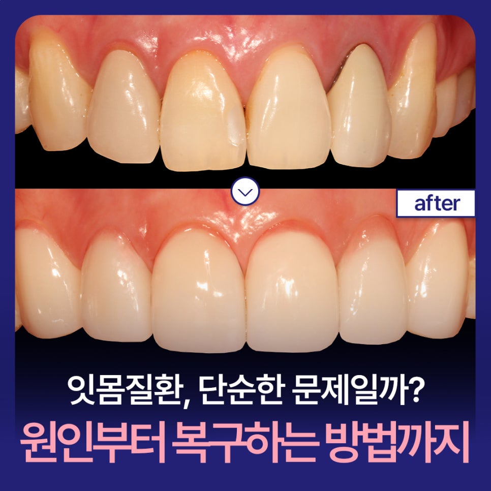Gum Disease: Is It Just a Simple Problem? From Its Causes to Ways to Restore It image 1