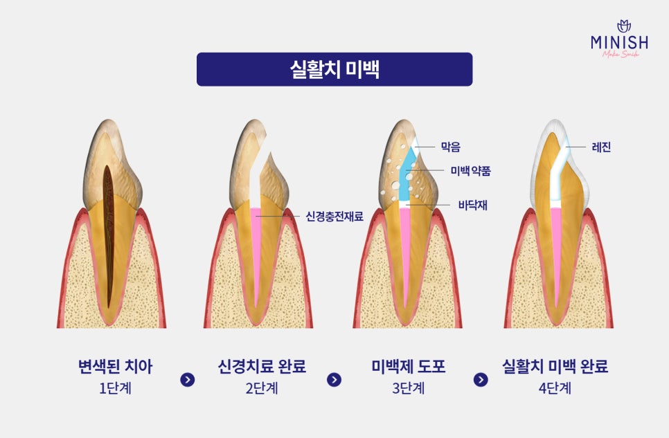 Yellow Teeth, From Causes to Solutions! Which Method Is Right for Me? image 6