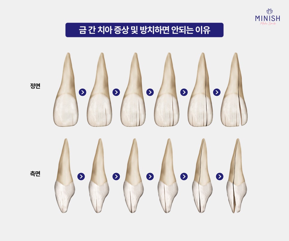 How Can Cracked Teeth Be Repaired Quickly and Healthily? A Complete Guide to Treatment Options image 3