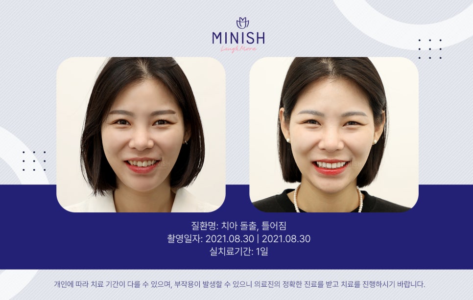 돌출입교정, 빠르게 치아의 비율까지 교정한다? 관련 이미지 6
