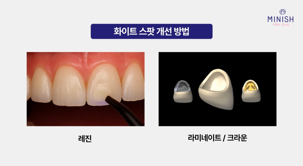 White Spots on Teeth: Worried About White Stains on Your Teeth? Here’s How to Improve Them Healthily! image 4