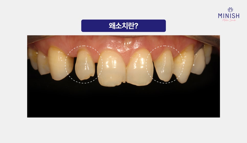작은치아 왜소치 교정 가장 좋은 방법은? 관련 이미지 2