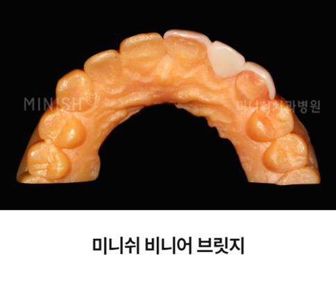 압구정역치과 임플란트 식립이 어려운 경우라면 관련 이미지 6