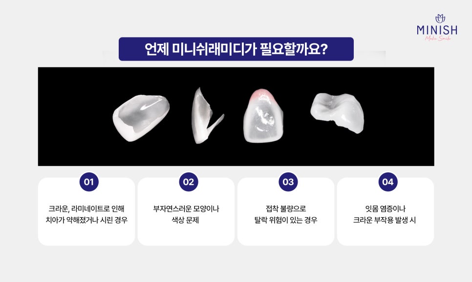 When Crown Retreatment Is Needed: The Tooth Restoration Solution Minish image 6