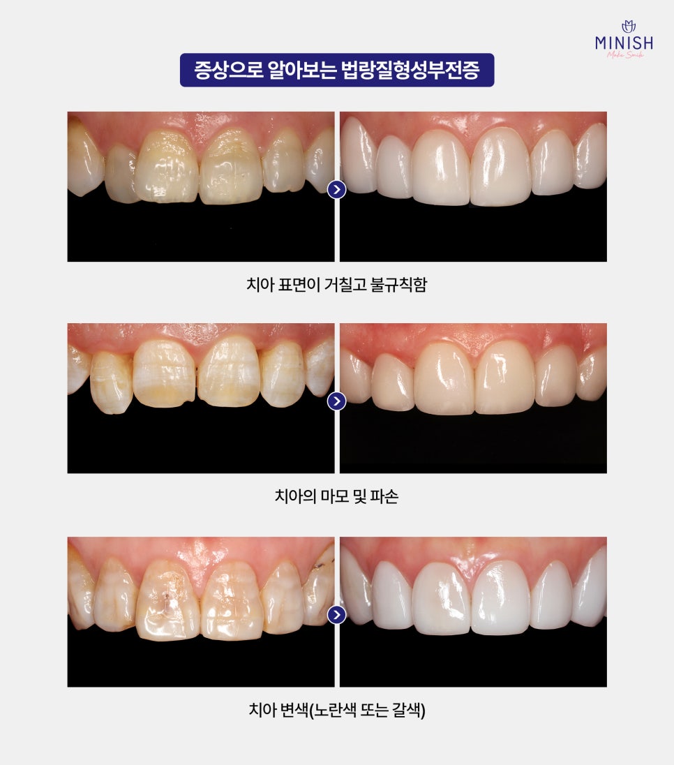 Rough, Speckled Tooth Surfaces? Enamel Hypoplasia image 3