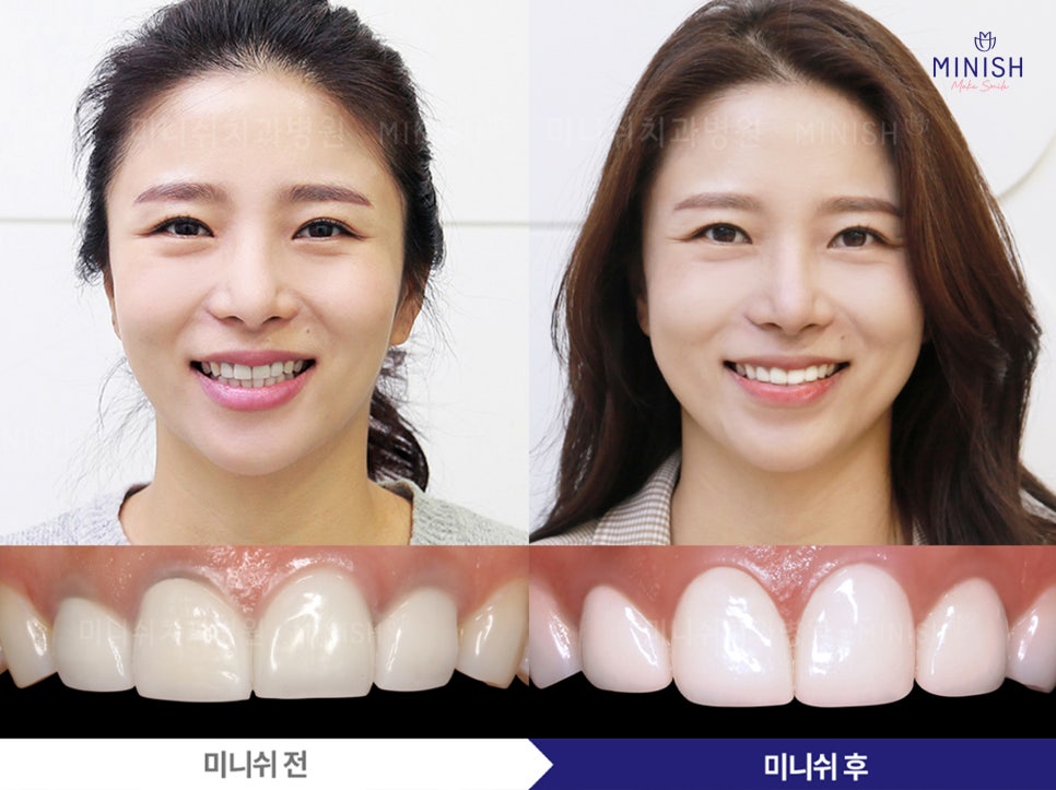 앞니 크라운 재치료가 필요하다면? 미니쉬로 건강하게 복구하세요 관련 이미지 6