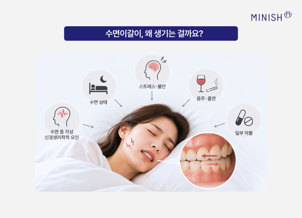 수면이갈이 원인과 증상, 이갈이 치료와 스플린트가 필요한 경우 관련 이미지 2