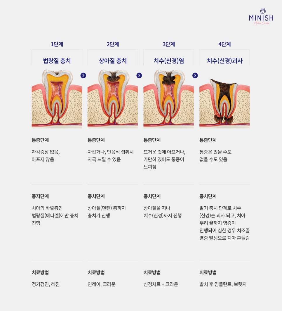 What Is the Best Way to Treat Cavities? What Is a Healthy Way to Protect My Teeth? image 2
