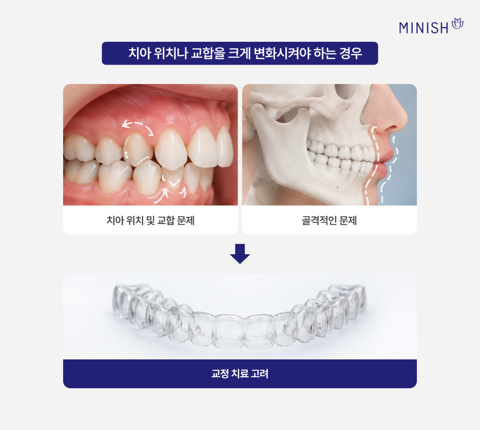 교정 후 들어간 입, 옥니 (옹니)가 고민, 미니쉬로 개선할 수 있을까? 관련 이미지 4