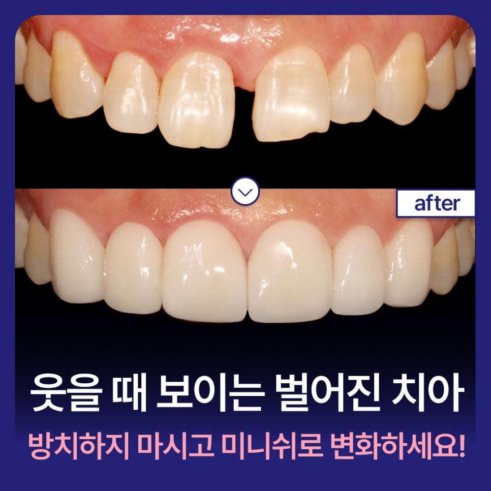 Don't Leave Gapped Teeth Visible When You Smile—Transform Them with Minishe! image 1