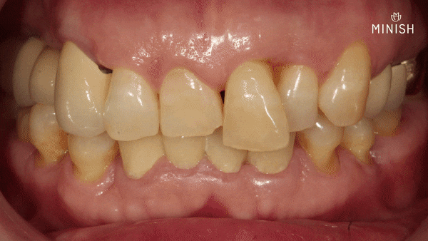 Protruding Front Teeth: How to Restore Both Health and Aesthetics When Crown Retreatment Is Needed! image 5