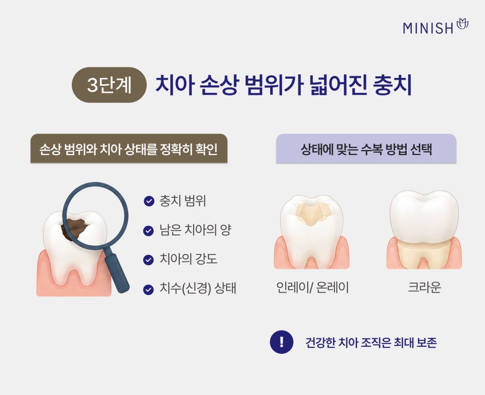 충치 단계별 치료 방법, 원데이 치료로 하루 만에 가능할까? 관련 이미지 5