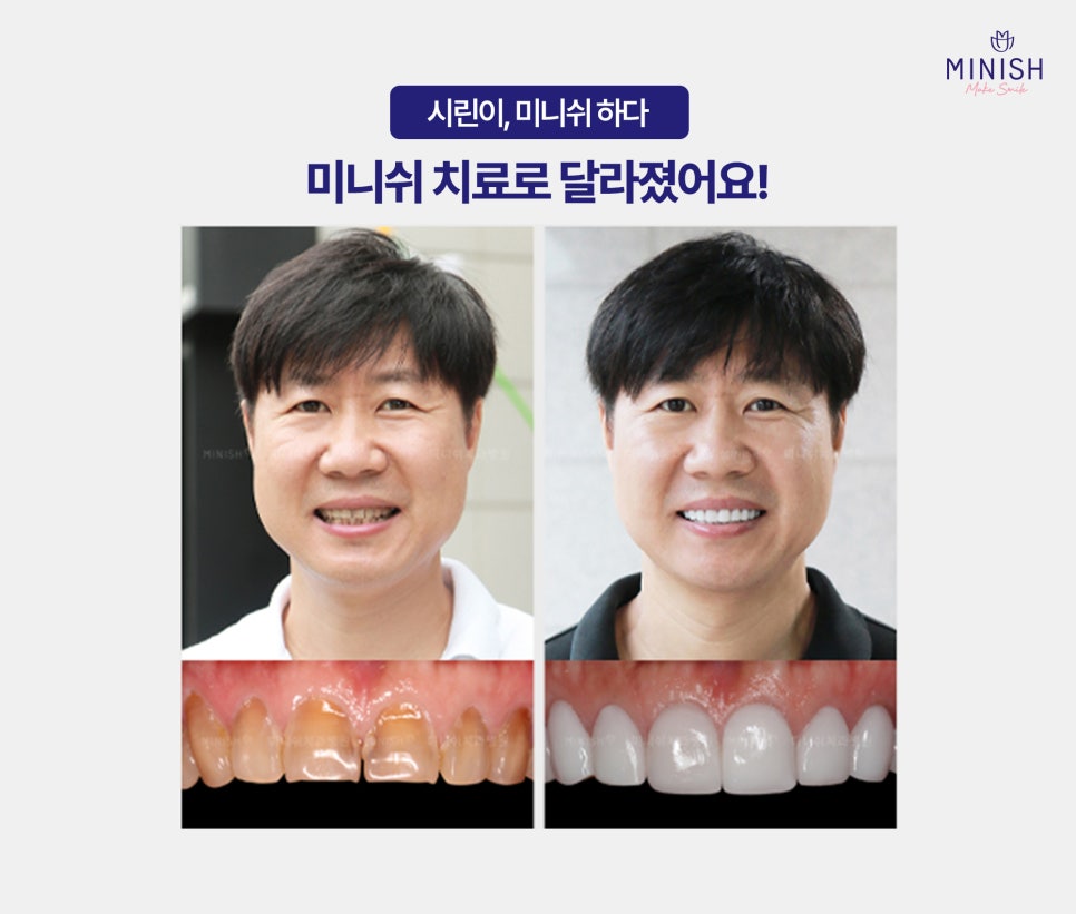 시린이 치료로 주목받는 미니쉬! 관련 이미지 9