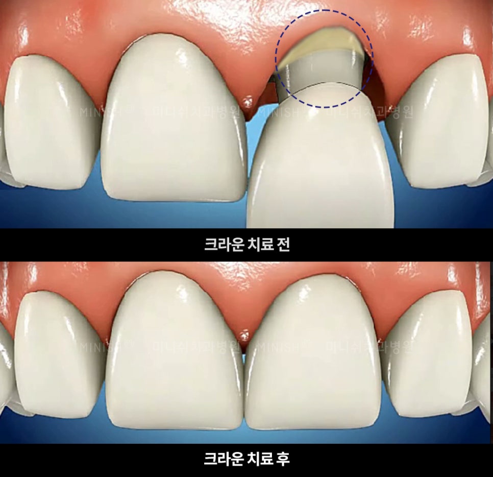 이가 시린 이유와 시린이 해결 방법 관련 이미지 6