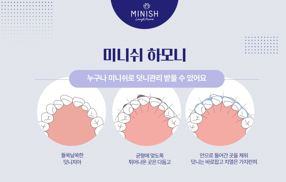 덧니교정, 왜 바로 잡아야 할까요? 관련 이미지 7