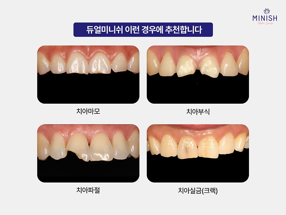 From Front Teeth to Molars, Which Minish Is Right for My Dental Condition? image 3