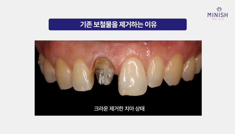 Should a Discolored Front Tooth Crown Be Replaced? Minish Revive for Retreatment image 4