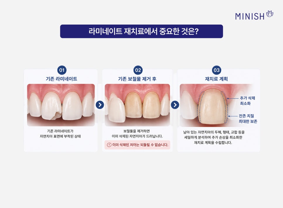 앞니 라미네이트 깨짐, 재치료가 필요하다면? 관련 이미지 4